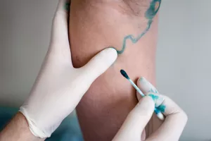 Vascular surgeon marking up veins on patient's leg with die before surgery.